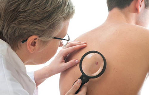 Cảnh giác: vết bầm nhỏ có thể là dấu hiệu của ung thư da