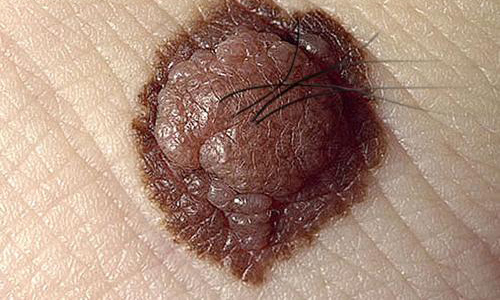 Cảnh giác: vết bầm nhỏ có thể là dấu hiệu của ung thư da
