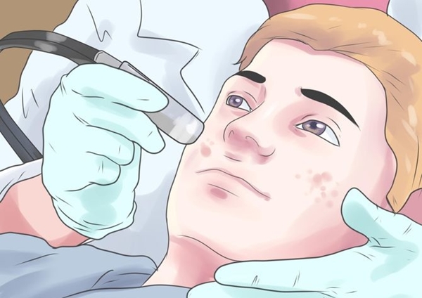 Các phương pháp đặc trị mụn cho da mặt (P.2)