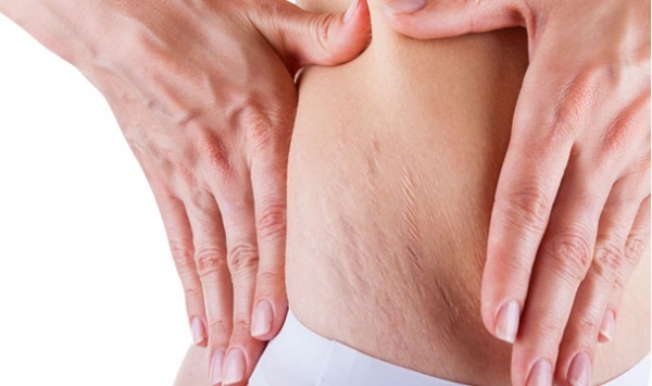 5 cách phòng ngừa và điều trị rạn da
