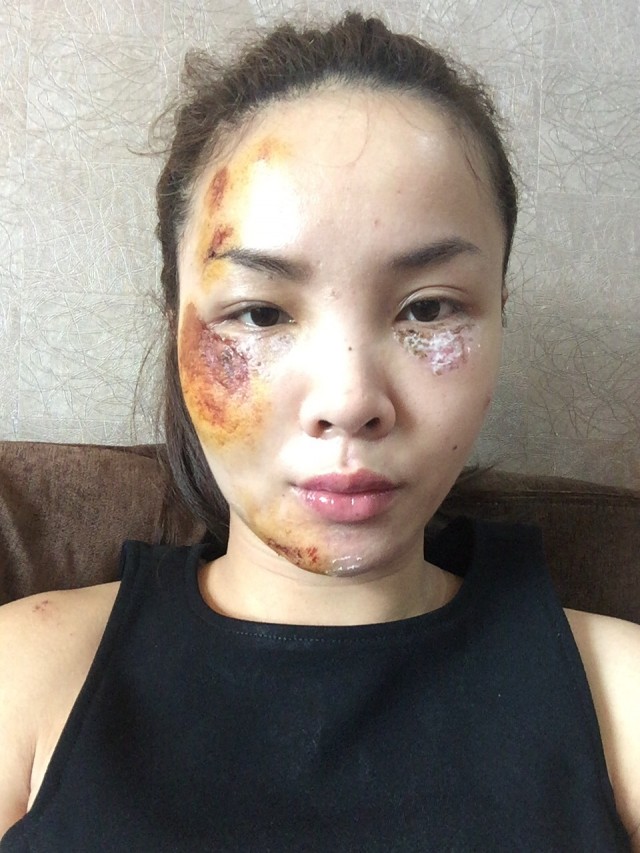 Yến Trang bức xúc vì bị ném đá khi lộ ảnh mặt bị thương.