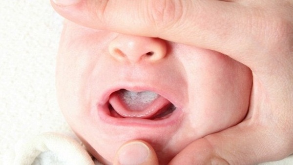 Nguyên nhân và cách điều trị bệnh tưa lưỡi ở trẻ sơ sinh    