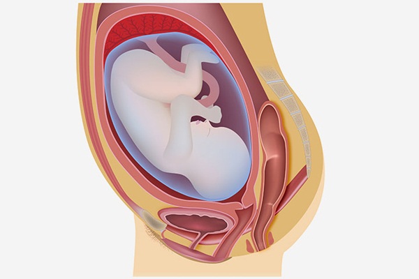 Cẩn trọng với viêm màng ối khi mang thai