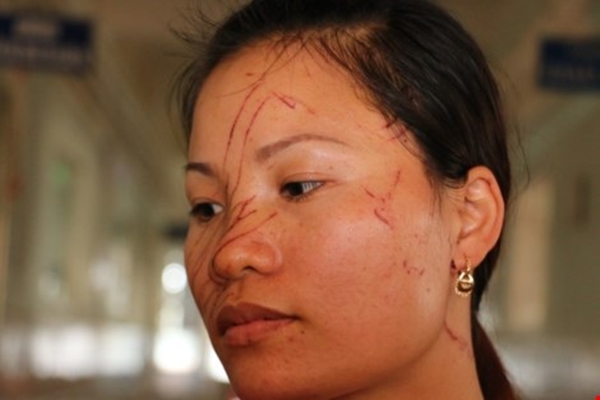 Chị Vân bị rạch nhiều vết trên mặt.
