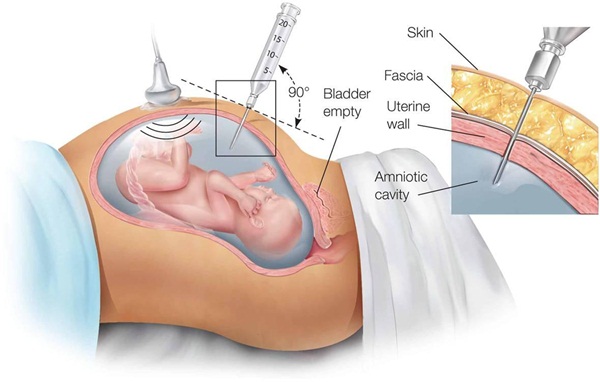 Các xét nghiệm cần thiết mẹ bắt buộc phải thực hiện trong thai kì (P3)