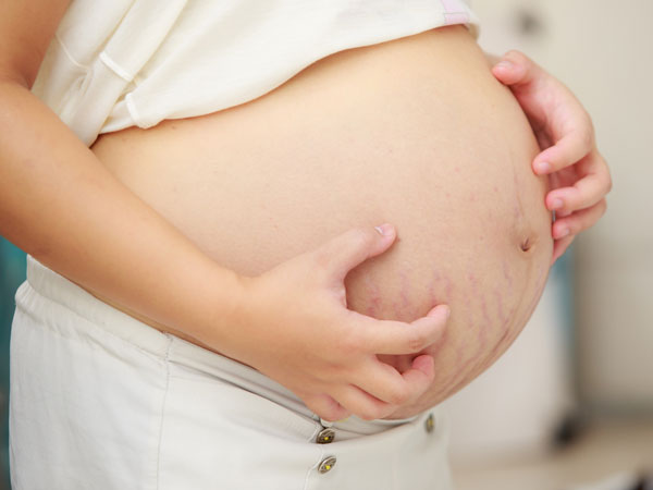 Mách bà bầu 8 mẹo giảm ngứa bụng khi sắp “vỡ chum”
