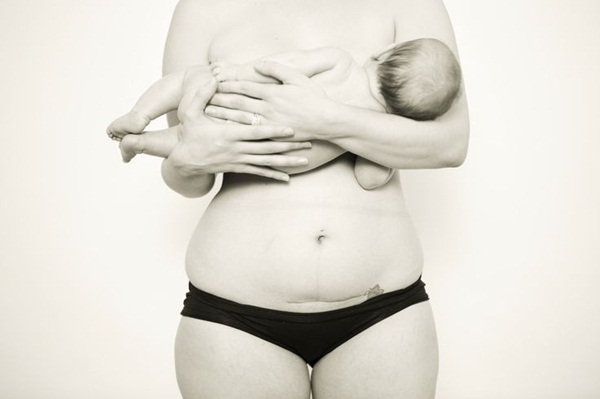 Phục hồi sức khỏe sau sinh mổ: những câu hỏi thường gặp nhất