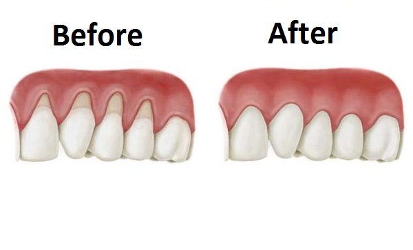 4 cách “cứu vãn” tình trạng lợi tụt khỏi chân răng