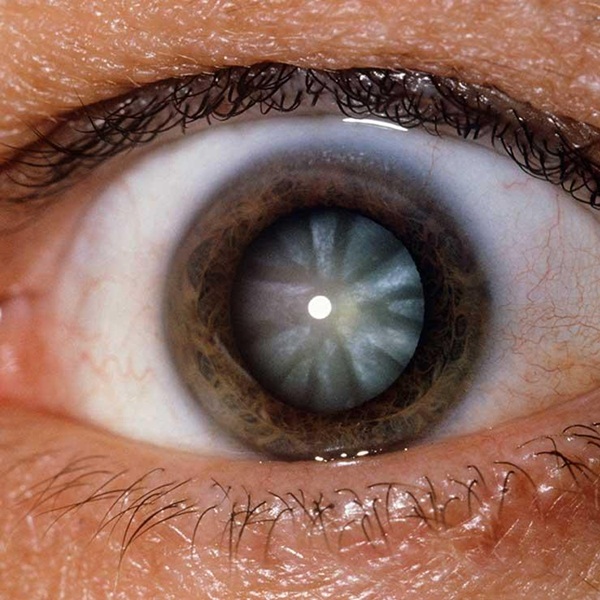 Màu mắt và những vấn đề sức khỏe có liên quan