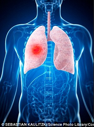 Tế bào trong phổi, xương dễ bị ung thư nhất