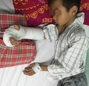 Nối bàn tay bị đứt gần lìa cho bé trai 8 tuổi