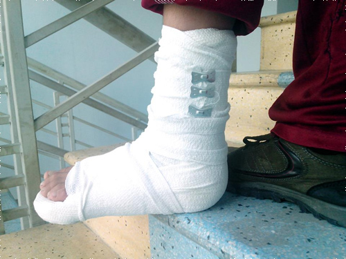 Những biến chứng nguy hiểm đối với bệnh nhân bị gãy xương chân không được điều trị đúng cách