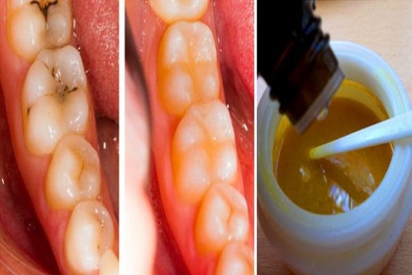 Công thức trị dứt điểm sâu răng, mảng bám và giúp răng siêu trắng