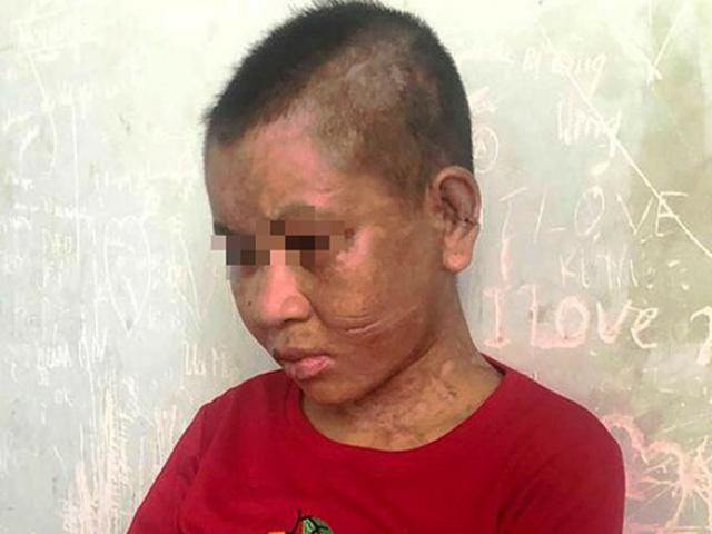 Lời kể rùng rợn của cô gái nghi bị chủ tra tấn dã man