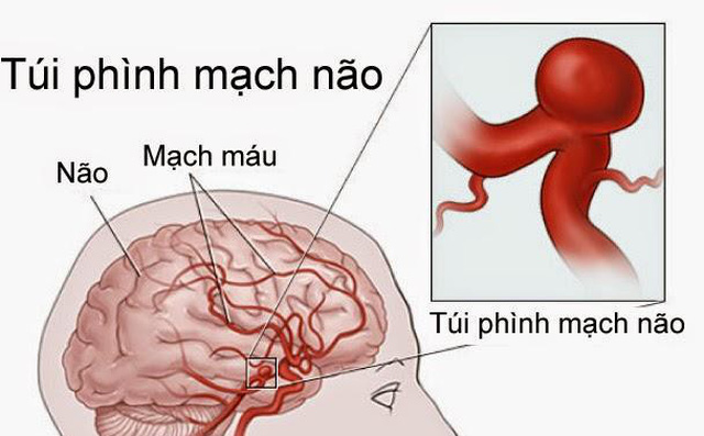 Bé trai mới 5 tuổi ở Long An đã bị đột quỵ và lời cảnh báo của bác sĩ chuyên khoa