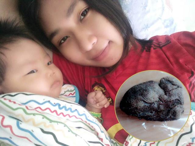 2 tháng sau mổ lấy thai, mẹ sụt 18kg rồi qua đời, khám nghiệm tiết lộ lỗi của bác sĩ