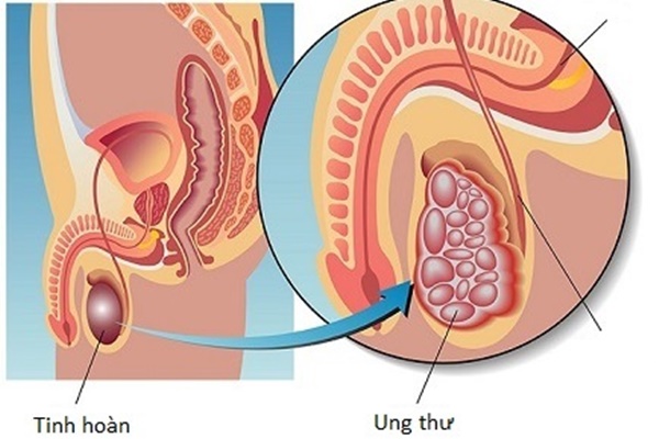 3 căn bệnh ung thư nếu phát hiện sớm ở đàn ông có thể chữa khỏi hoàn toàn, dấu hiệu vô cùng dễ thấy