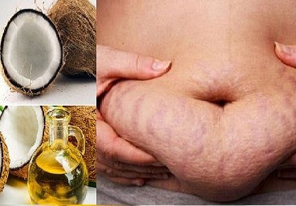 Tận dụng nguyên liệu rẻ tiền trong bếp, mẹ sau sinh trị rạn da dễ dàng, làn da mịn màng trở lại