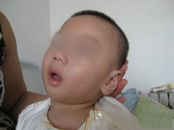 Thấy con chưa đầy 3 tháng đã biết gật đầu đáp chuyện, mẹ tưởng con thông minh, không ngờ đứa trẻ bị bại não