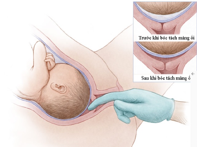 Tách màng ối - phương pháp kích thích chuyển dạ tự nhiên nhiều mẹ bầu chưa biết