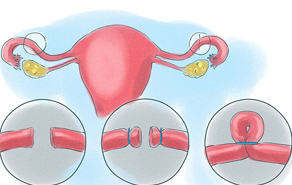 Thắt ống dẫn trứng dễ gây vô sinh?
