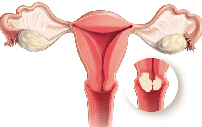 4 dấu hiệu sớm nhận biết ung thư cổ tử cung