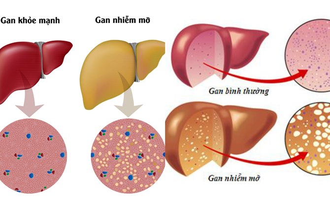 Việc cần làm khi bị bệnh gan nhiễm mỡ