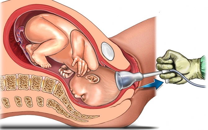 Sinh thường - mẹ nên biết về các dụng cụ trợ sinh