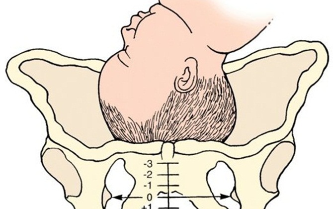 Mất cân đối đầu và xương chậu khi sinh nở - mẹ phải làm sao?