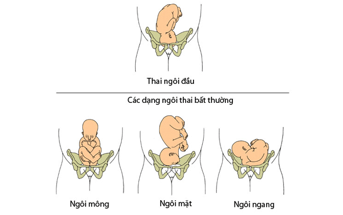 Các trường hợp ngôi thai không thuận lợi để sinh thường