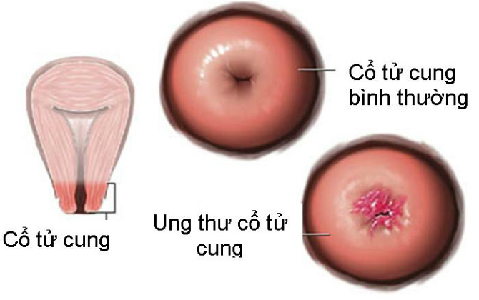 "Triệt hạ" nỗi lo ung thư cổ tử cung bằng tiêm vắc-xin