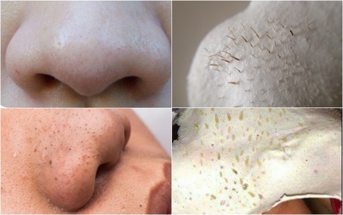 Đừng nhầm lẫn sợi bã nhờn với mụn đầu đen 