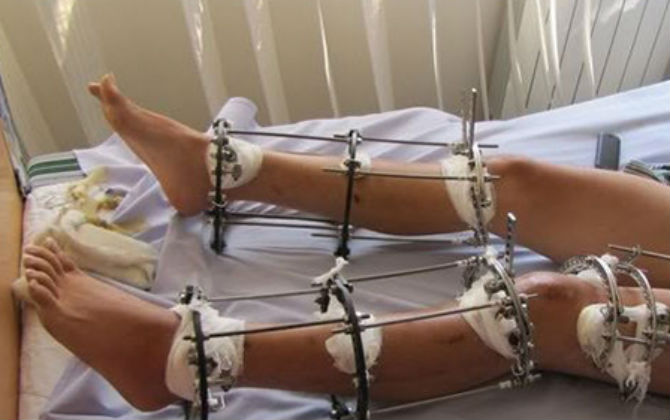 Lạnh sống lưng xem tường tận quá trình kéo dài chân làm đẹp