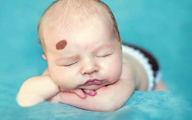 Để không còn phiền lòng vì bớt bẩm sinh