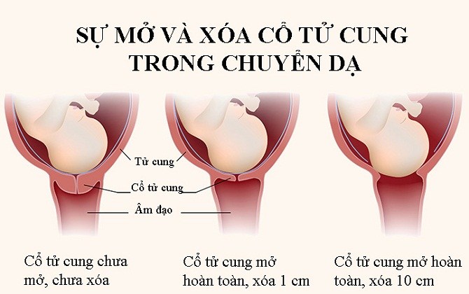 Những bước thay đổi của cổ tử cung trong chuyển dạ và sinh nở