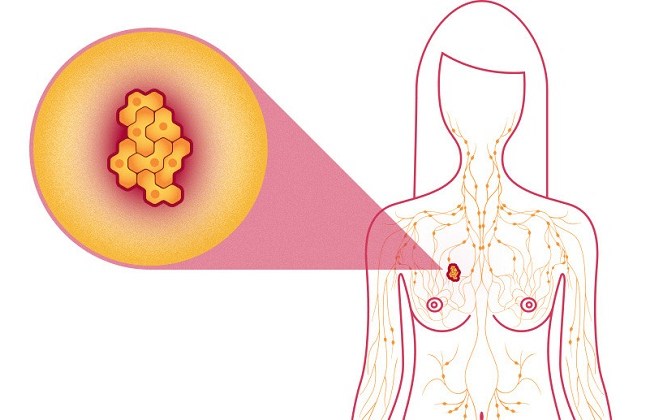 10 điều phụ nữ hiện đại nhất định phải biết về ung thư vú