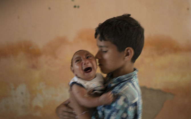 Virus Zika gây teo não: Chẩn đoán các ca bệnh không dễ dàng?