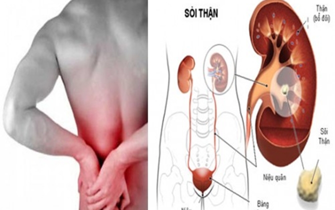 Người bị sỏi thận nên và không nên ăn gì?