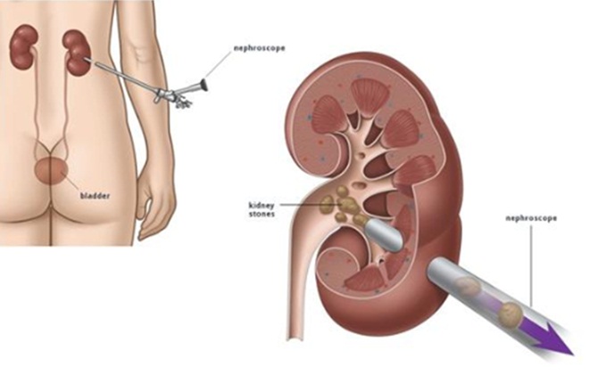 Điều trị sỏi thận cỡ lớn bằng phương pháp nào?