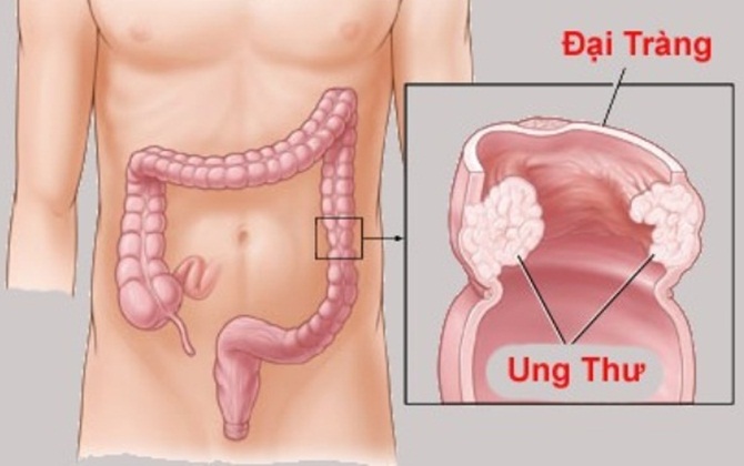 Bệnh ung thư Trần Lập mắc phải: vì sao tiên lượng tốt nhưng tỉ lệ tử vong cao?