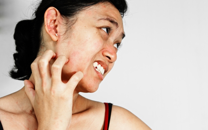 Bài thuốc đơn giản từ tự nhiên loại bỏ chứng dị ứng ánh nắng hè này