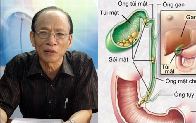 Chủ tịch Hội gan mật Việt Nam: Sỏi mật lành tính không bắt buộc phải điều trị