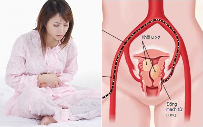 Chảy máu sau "yêu" mới phát hiện bị u xơ tử cung