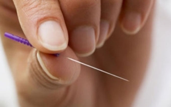 Sự thật về thuật cứu mạng người bị tai biến, đột quỵ chỉ bằng một cây kim 
