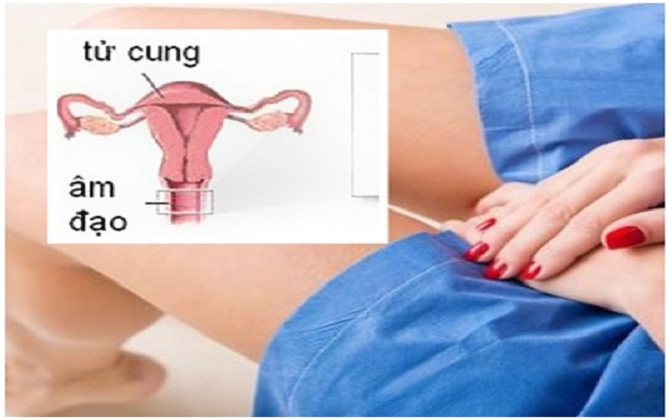 Dùng thuốc đặt âm đạo, coi chừng bệnh ngày càng nặng vì đặt không đúng cách