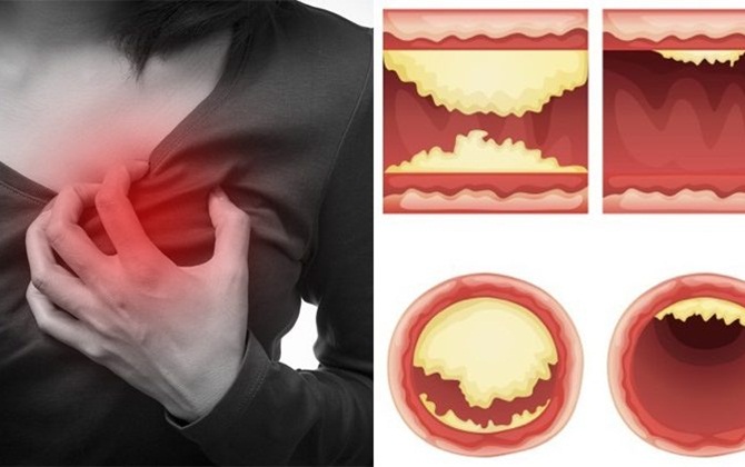 Ai cũng có thể loại trừ 88% nguy cơ đau tim và đột quỵ nhờ việc làm rất đơn giản này