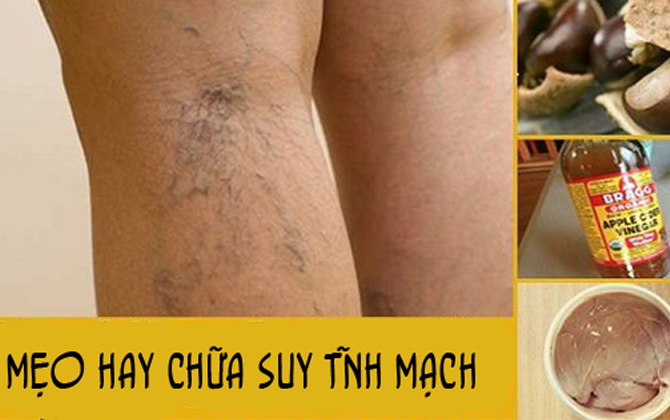 Mẹo hay chữa suy giãn tĩnh mạch chân từ nguyên liệu tự nhiên