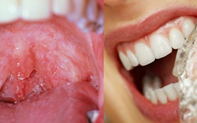 Đây là điều sẽ xảy ra khi uống nước đá liên tục mỗi ngày vào mùa hè