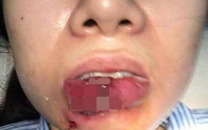 Bác sĩ cảnh báo chất làm đầy "rởm" gây hậu quả nặng nề