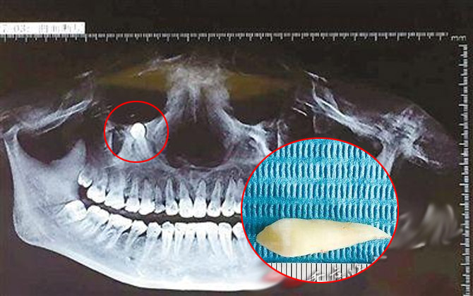 Hoảng hồn cô gái bị mọc răng nanh dưới mắt